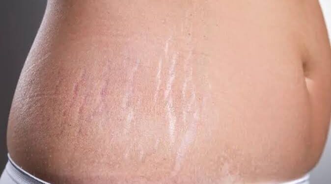 4 طرق طبيعية للتخلص من علامات التمدد المزعجة