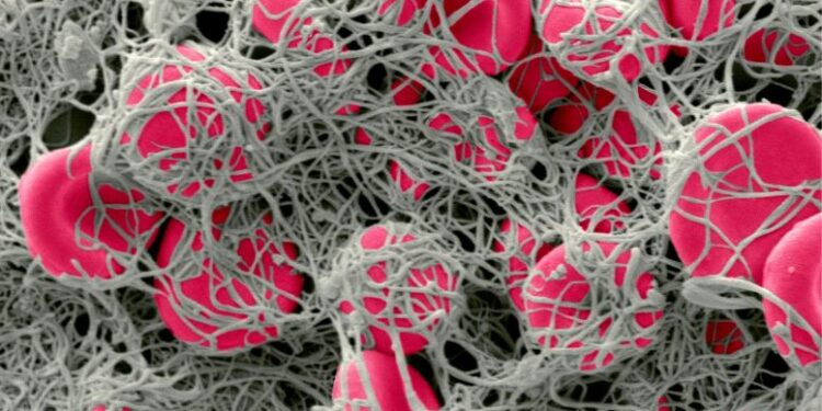 جلطات دموية لدى مرضى كورونا تحفزها أجسام مضادة “مارقة”