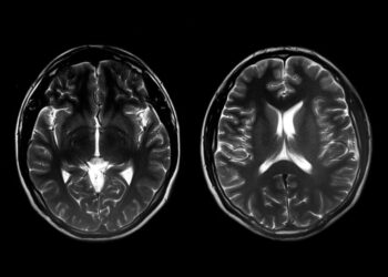 بحث جديد يُظهر الاختلافات بين أدمغة الفتيات والفتيان المصابين بالتوحد