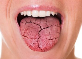 ما هو جفاف الفم؟ تعرف على الأعراض والأسباب والعلاج