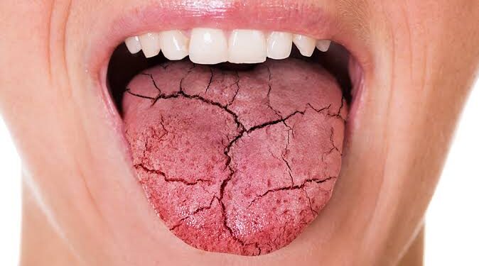 ما هو جفاف الفم؟ تعرف على الأعراض والأسباب والعلاج