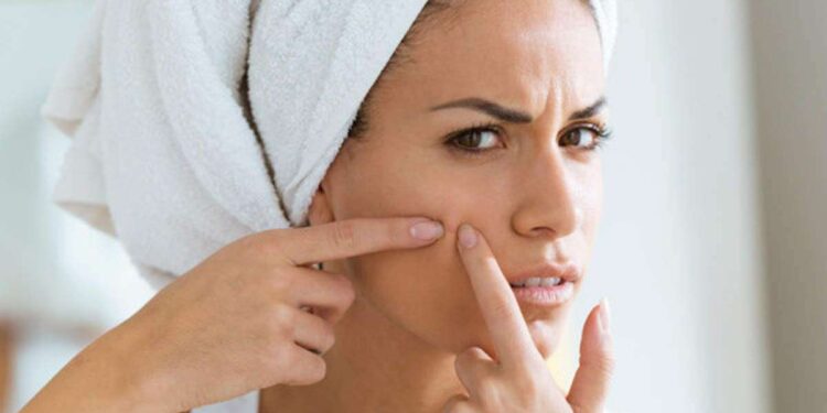 خل التفاح لعلاج حب الشباب.. هل يؤدي إلى منع البثور فعليًا؟