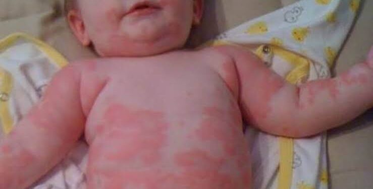 أهم 5 أساطير حول التهاب الجلد التحسسي