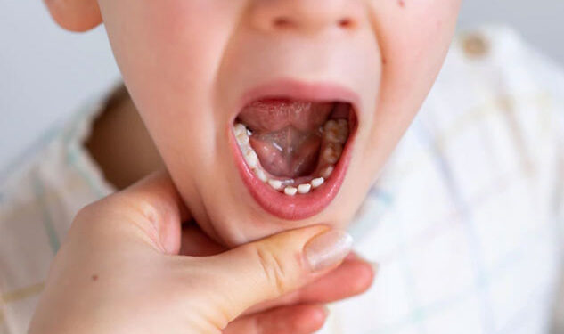 أسباب وعلاج تسوس الأسنان عند الأطفال